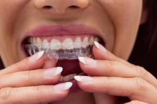 Можно ли выровнять зубы без брекетов?