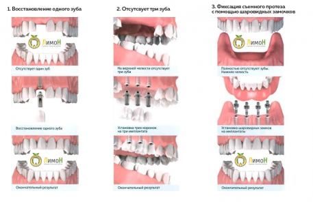 варианты работ по протезированию зубов на имплантах