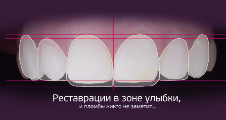 цены на реставрация зубов в Москве