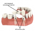 мостовидное протезирование зубов