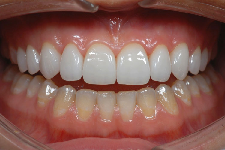 виниры emax на зубах - фото