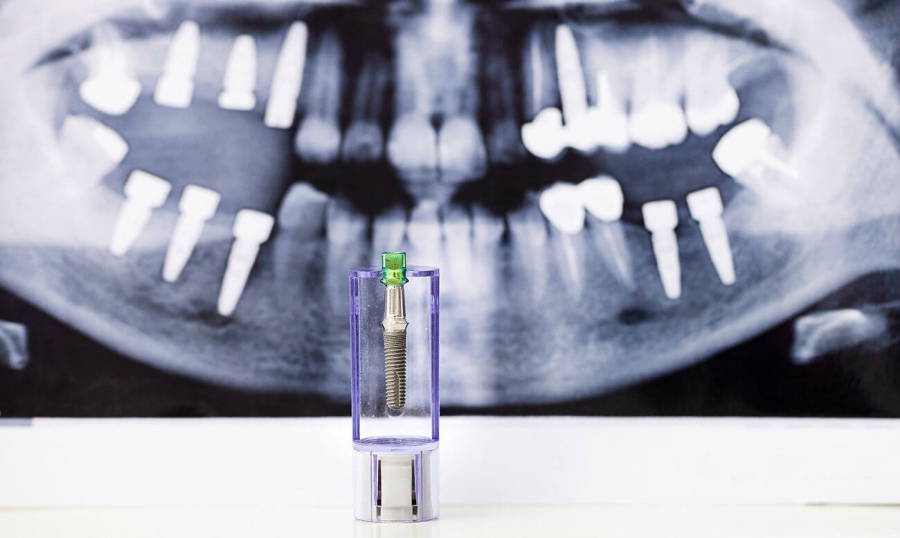 Имплантация зубов Astra Tech под ключ акция