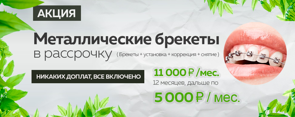 Металлические брекеты под ключ 108000 руб. за 12 месяцев за одну челюсть в Москве