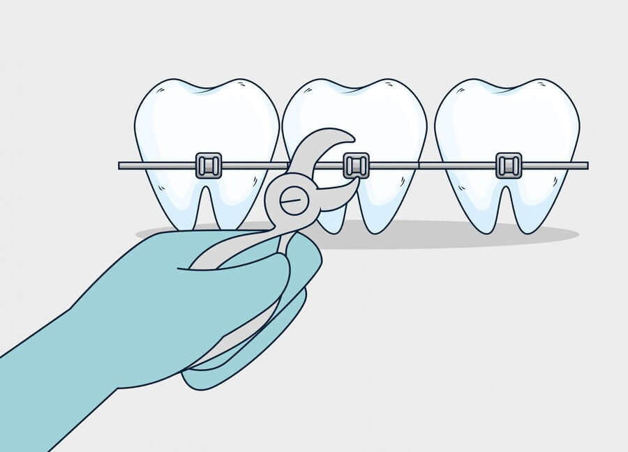 Этапы подготовки зубов к установке брекетов