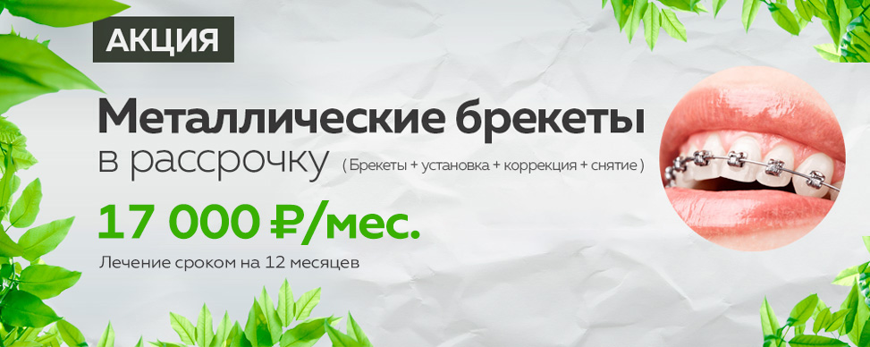 Металлические брекеты под ключ 108000 руб. за 12 месяцев за одну челюсть в Москве