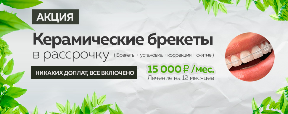 Керамические брекеты в рассрочку 15000 руб за одну челюсть в Москве